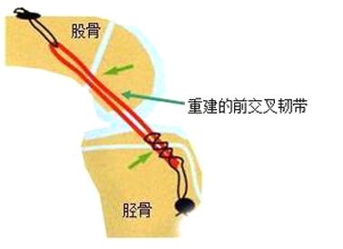 重塑骨骼健康，最新治骨方法與自信成就感的旅程