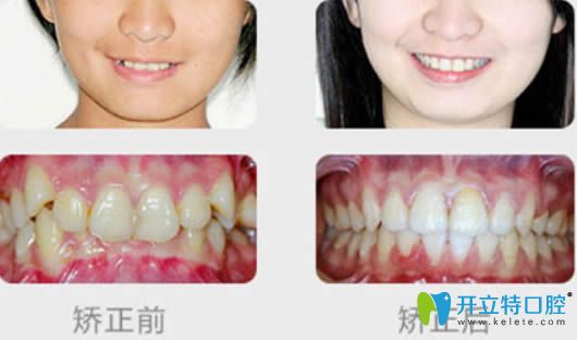 隱適美矯正價格揭秘，小巷深處的隱形魅力費用探討